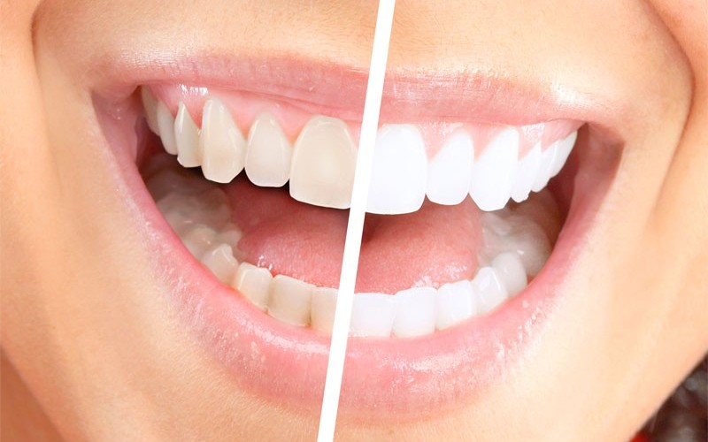 Bělení zubů